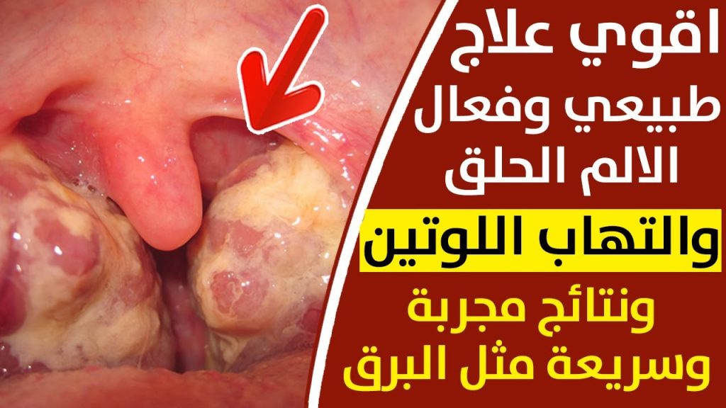 ودّع آلام الحلق: علاجات منزلية مذهلة للوزتين بدون أدوية